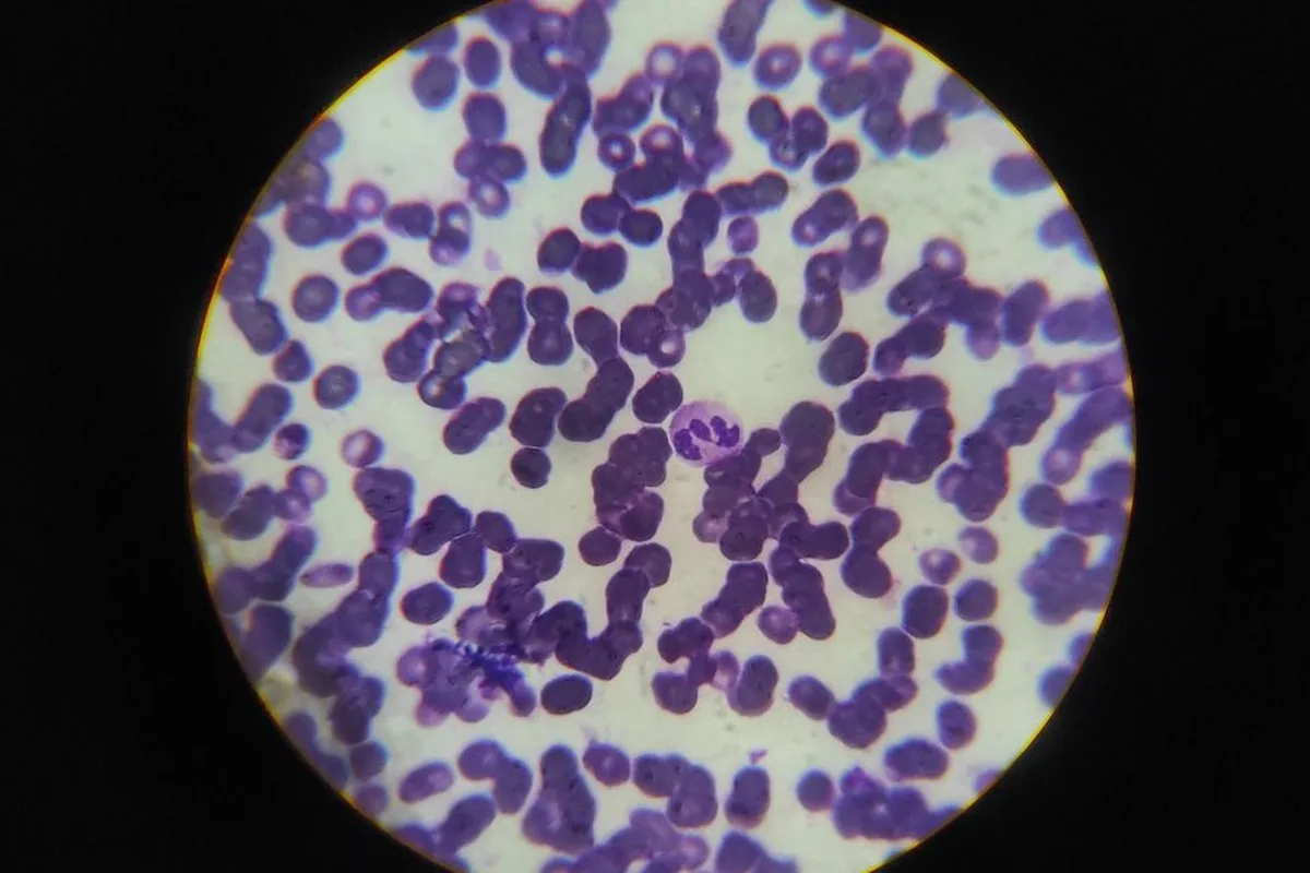 A stained blood smear under the microscope, with a white blood cell among red blood cells